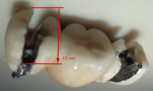 Импланты зубов виды и цены