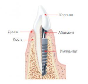 импланты зубов виды и цены